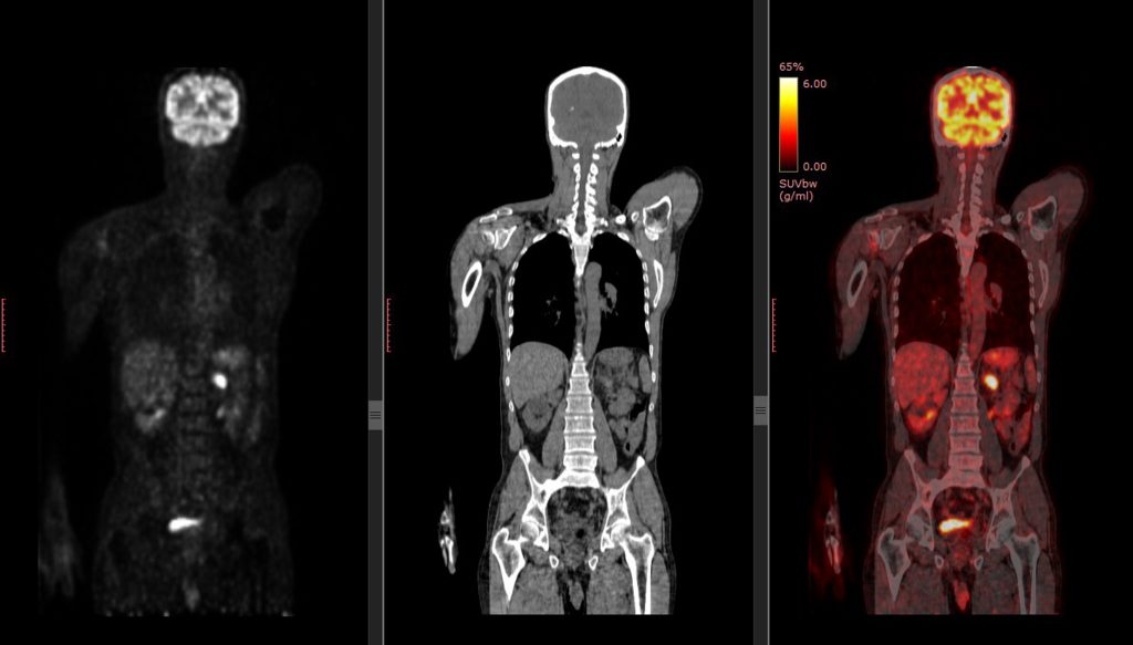 Pozitron Emisyon Tomografisi ve Bilgisayarlı Tomografi